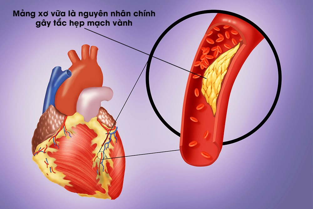 9 thực phẩm kiểm soát cholesterol và giảm nguy cơ mắc bệnh tim - Viện Huyết  học - Truyền máu Trung ươngViện Huyết học – Truyền máu Trung ương